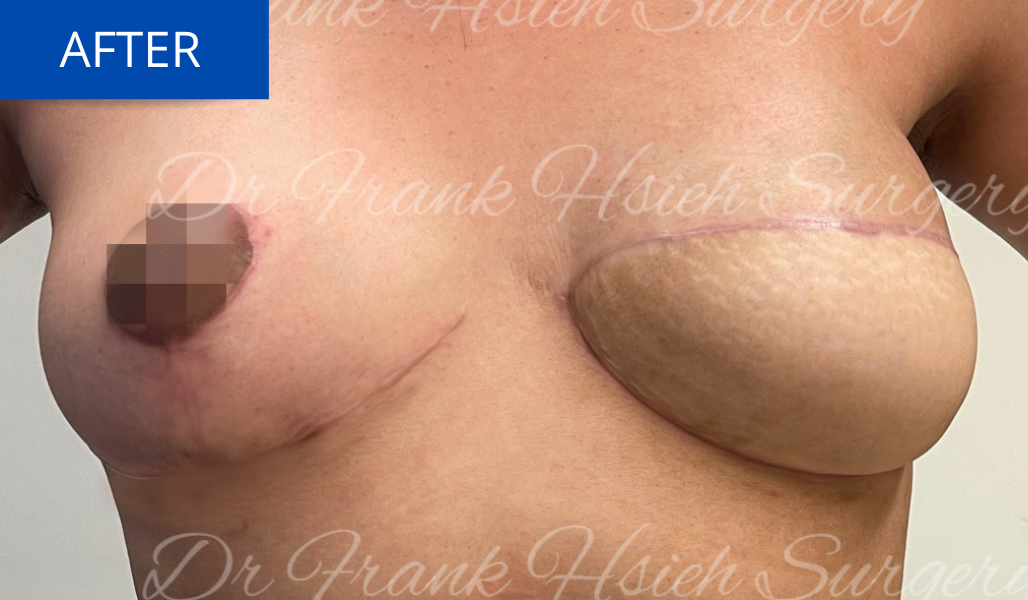Delayed Breast Reconstruction After