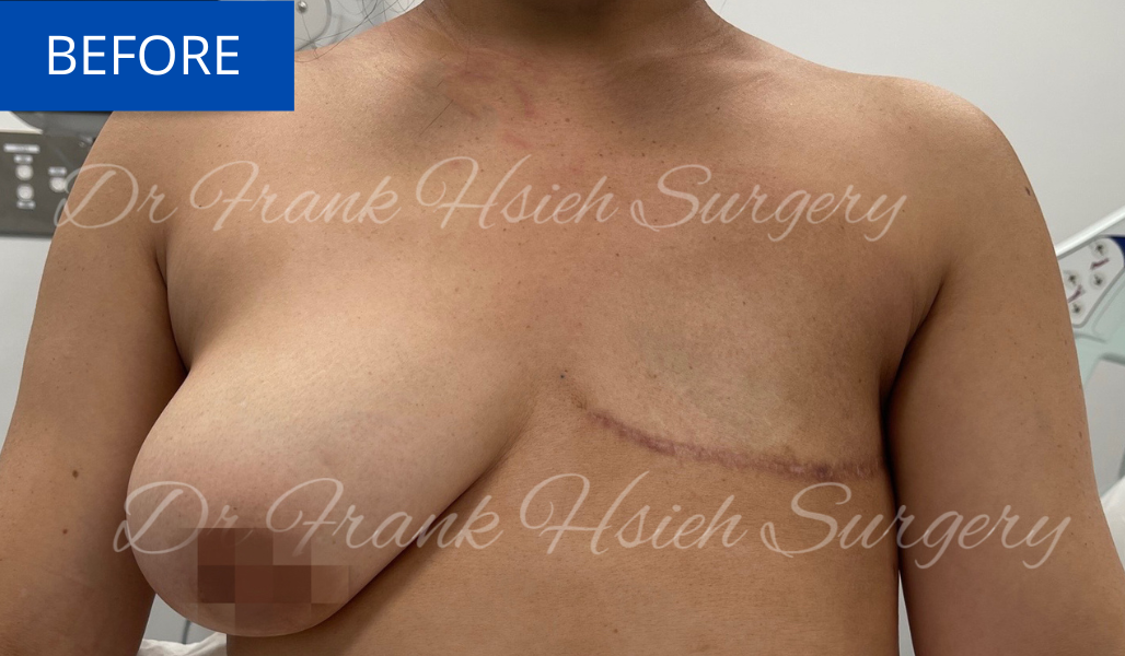 Delayed Breast Reconstruction Before