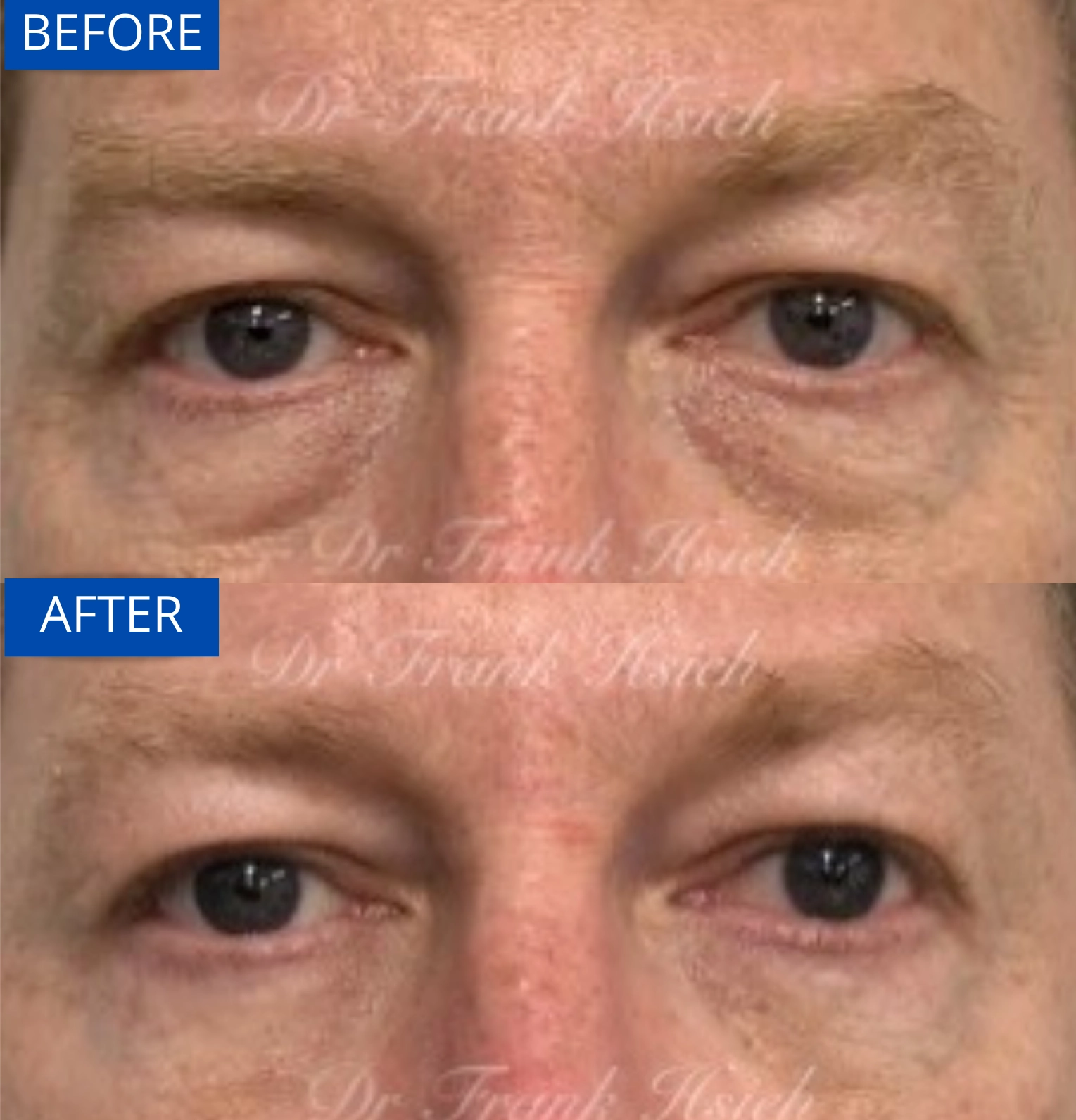 Eyebags Removal Lower Blepharoplasty Internal Scarless Case 1 Before and After