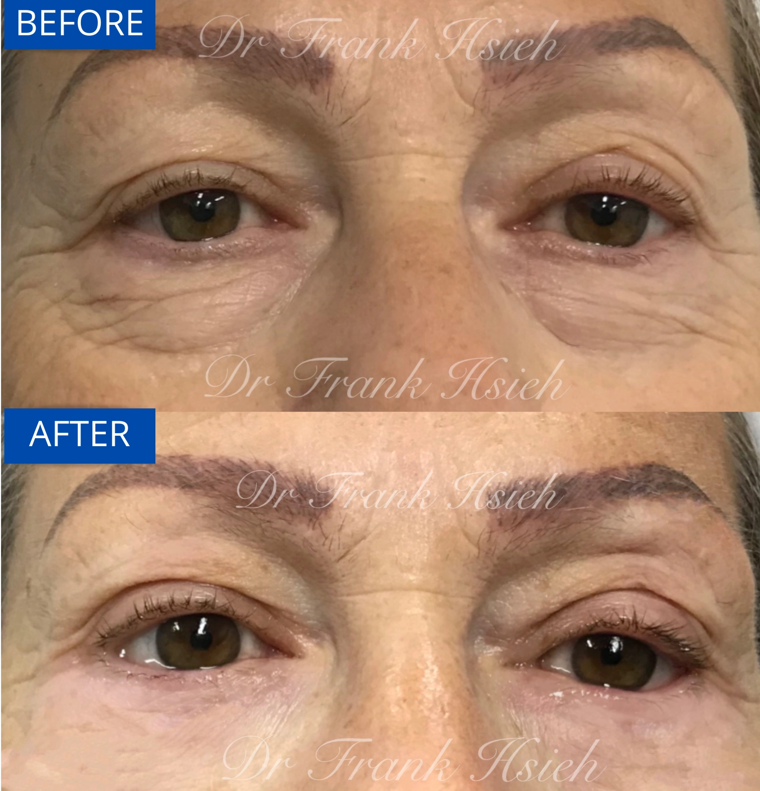 Eyebags Removal Lower Blepharoplasty Internal Scarless Case 10 Before and After