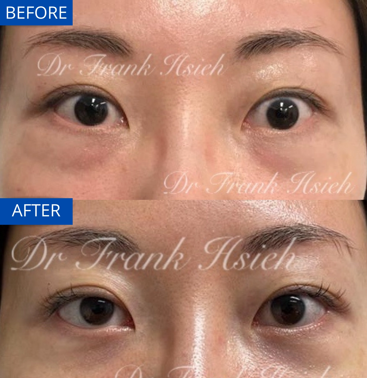 Eyebags Removal Lower Blepharoplasty Internal Scarless Case 11 Before and After