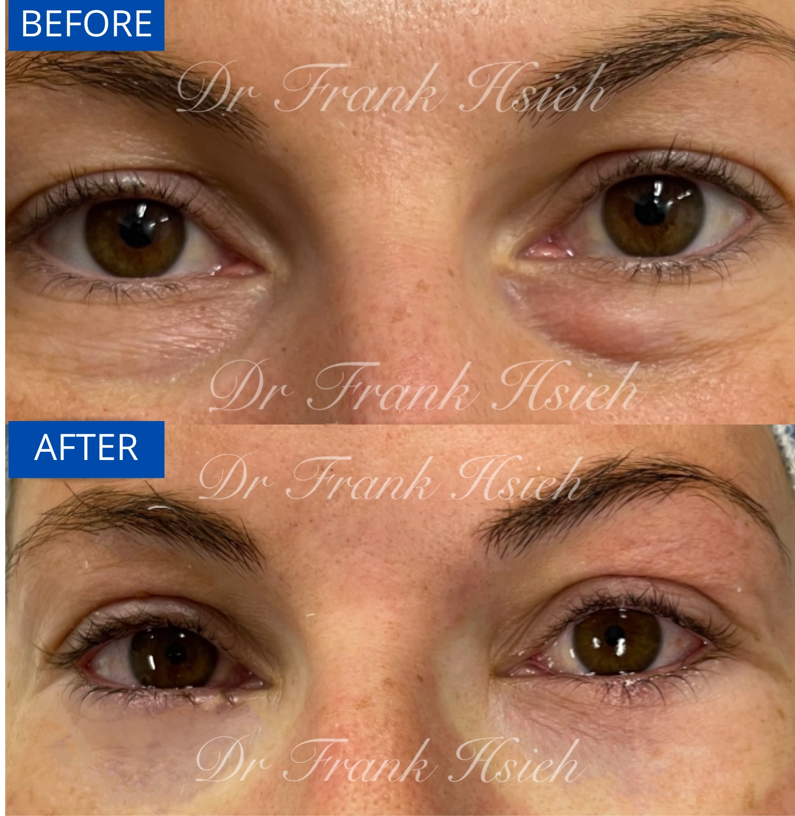 Eyebags Removal Lower Blepharoplasty Internal Scarless Case 12 Before and After