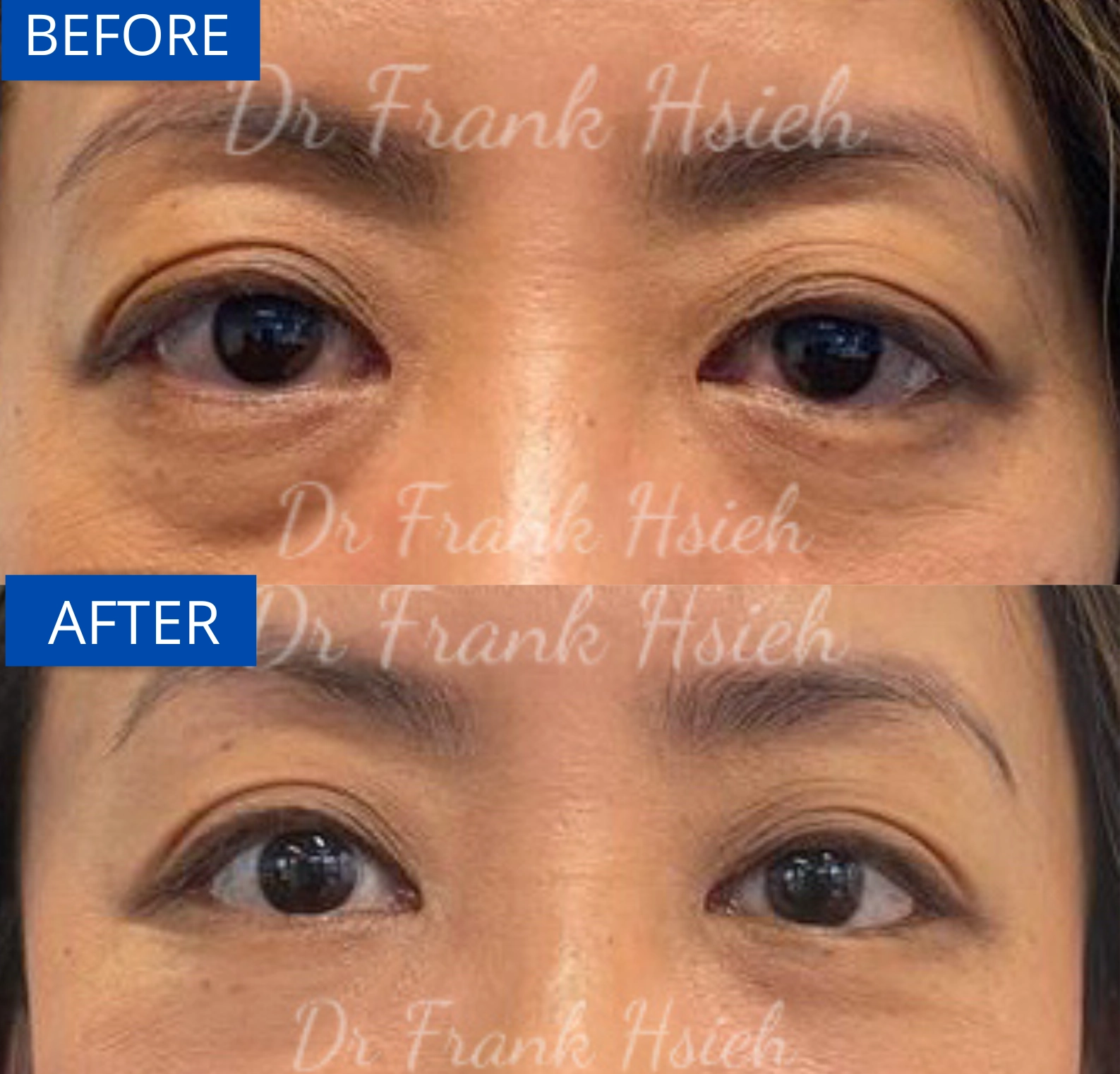 Eyebags Removal Lower Blepharoplasty Internal Scarless Case 13 Before and After