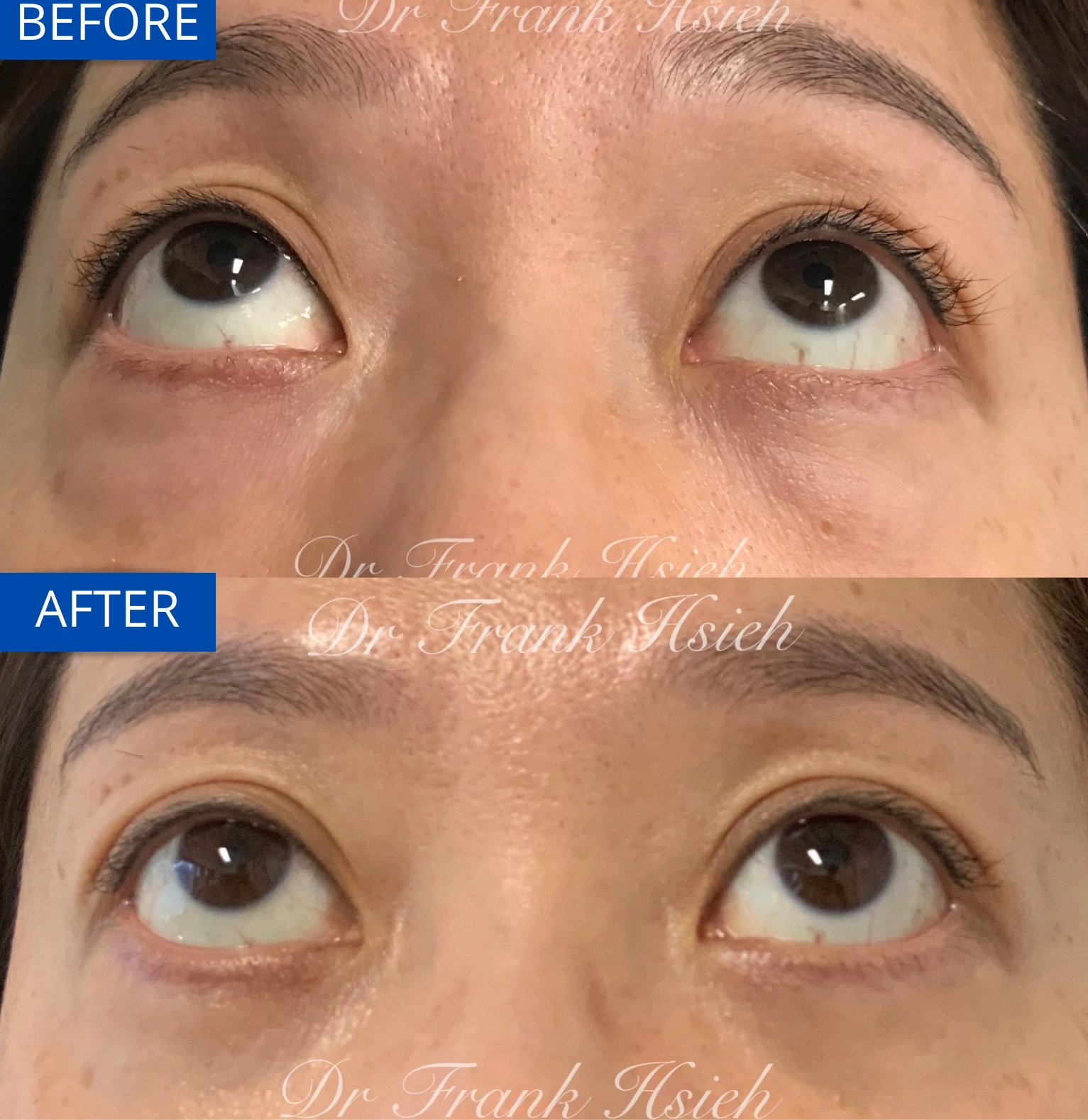 Eyebags Removal Lower Blepharoplasty Internal Scarless Case 14 Before and After Look Up