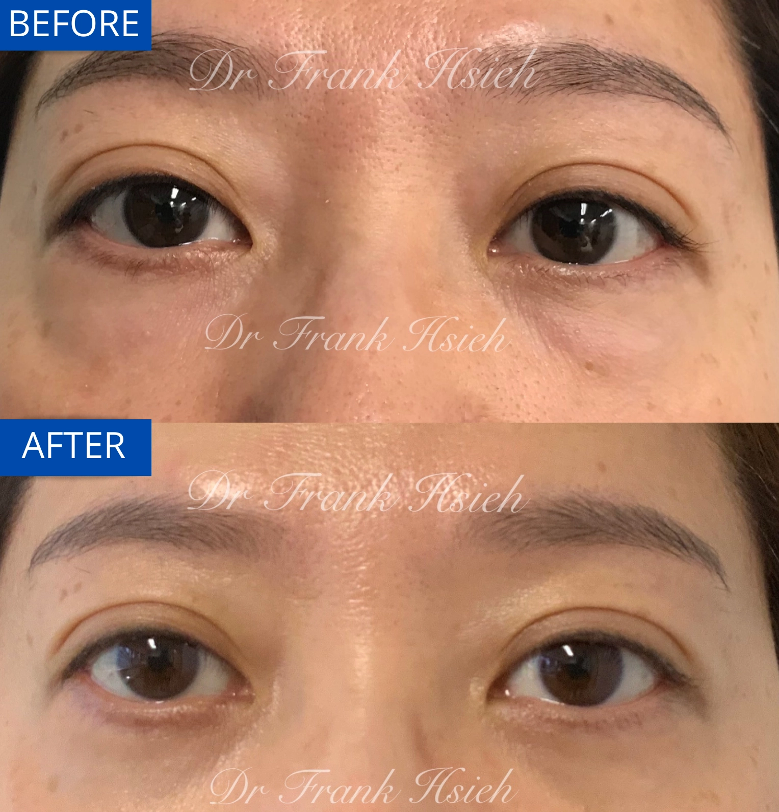 Eyebags Removal Lower Blepharoplasty Internal Scarless Case 14 Before and After
