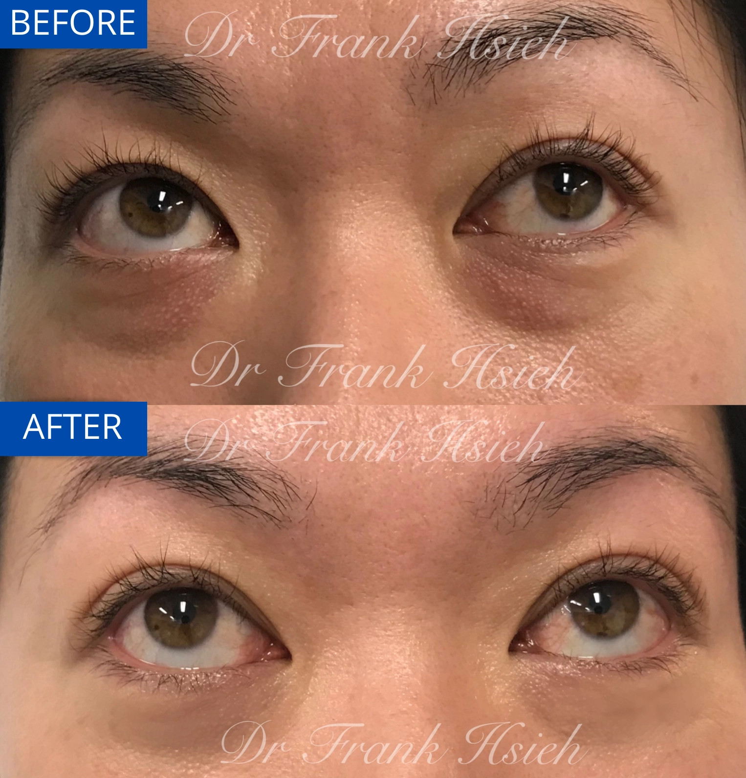 Eyebags Removal Lower Blepharoplasty Internal Scarless Case 15 Before and After Look Up