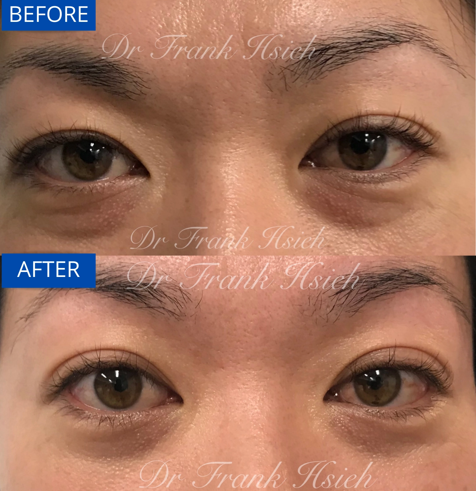 Eyebags Removal Lower Blepharoplasty Internal Scarless Case 15 Before and After