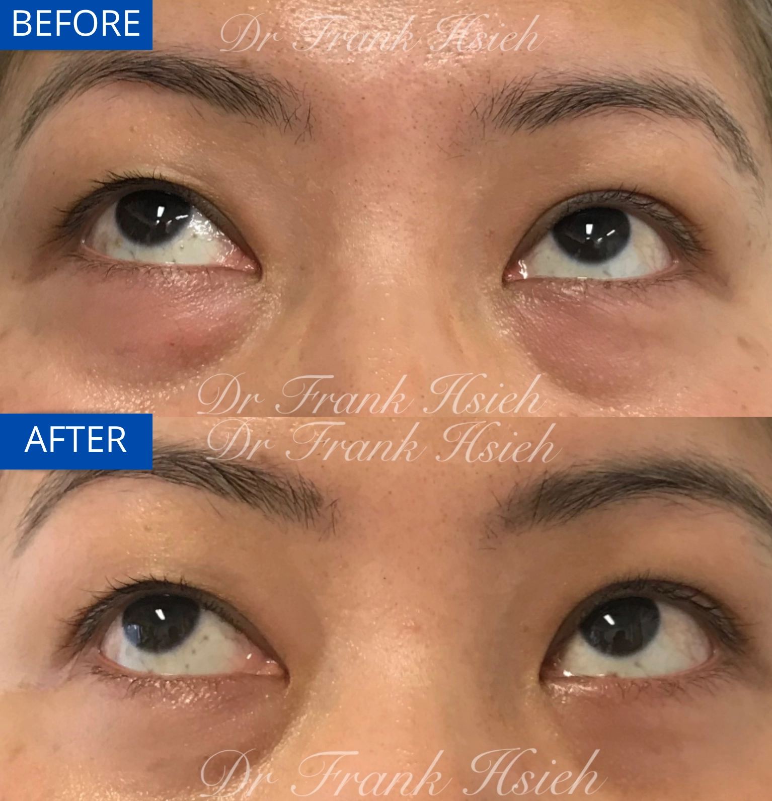 Eyebags Removal Lower Blepharoplasty Internal Scarless Case 16 Before and After Look Up
