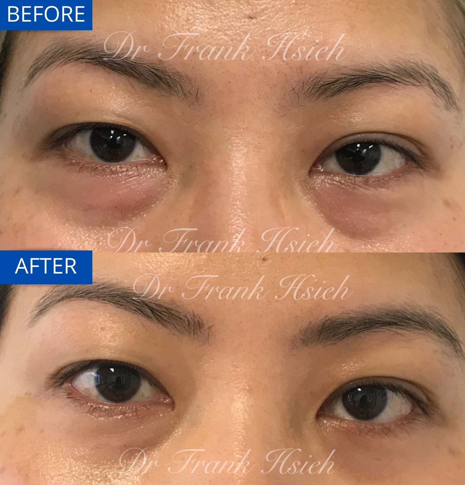 Eyebags Removal Lower Blepharoplasty Internal Scarless Case 16 Before and After