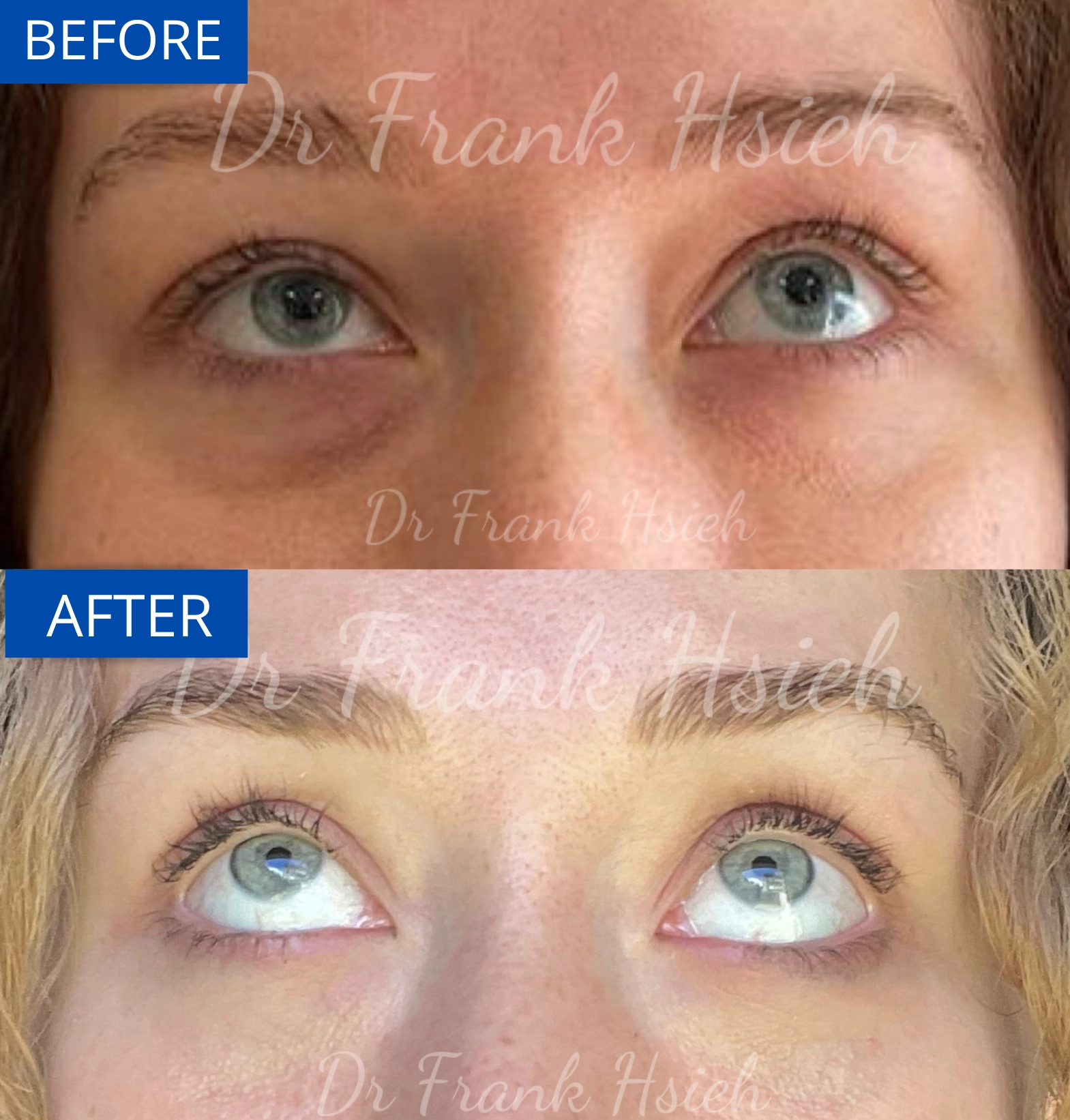Eyebags Removal Lower Blepharoplasty Internal Scarless Case 17 Before and After Look Up