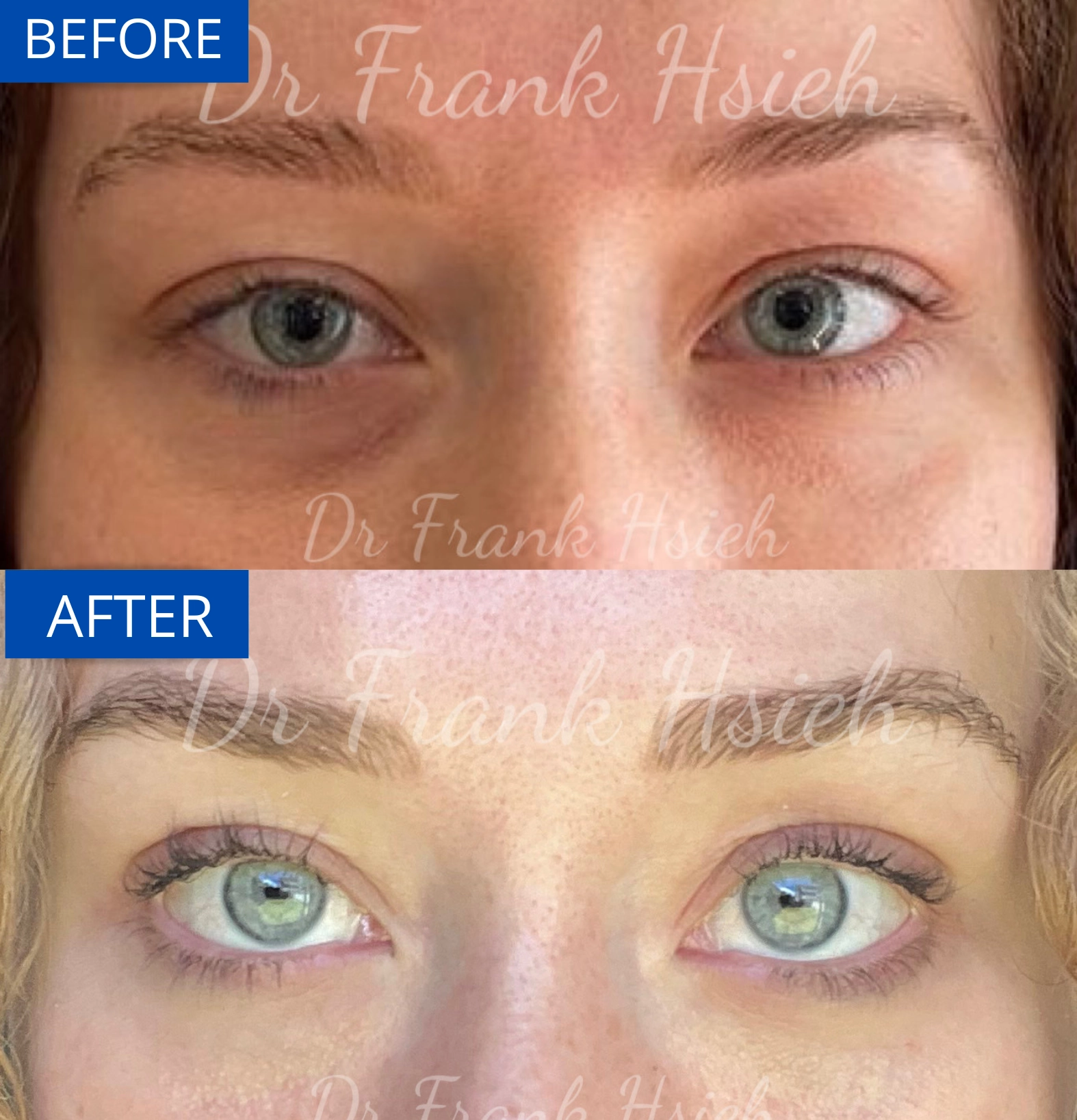 Eyebags Removal Lower Blepharoplasty Internal Scarless Case 17 Before and After