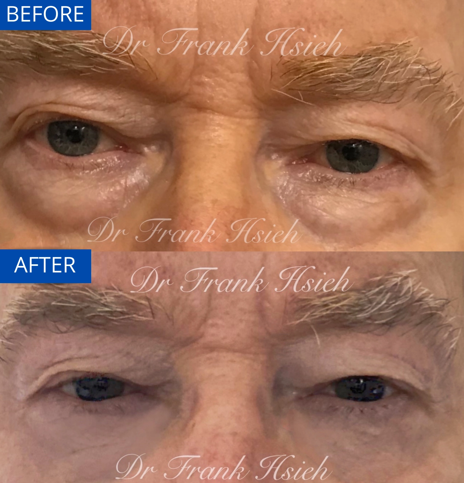 Eyebags Removal Lower Blepharoplasty Internal Scarless Case 2 Before and After
