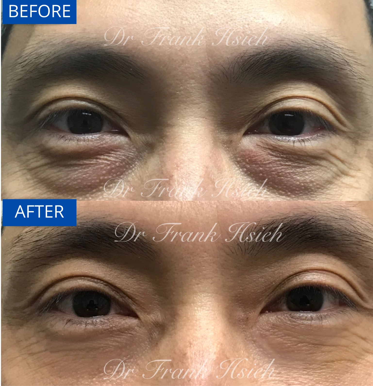 Eyebags Removal Lower Blepharoplasty Internal Scarless Case 3 Before and After