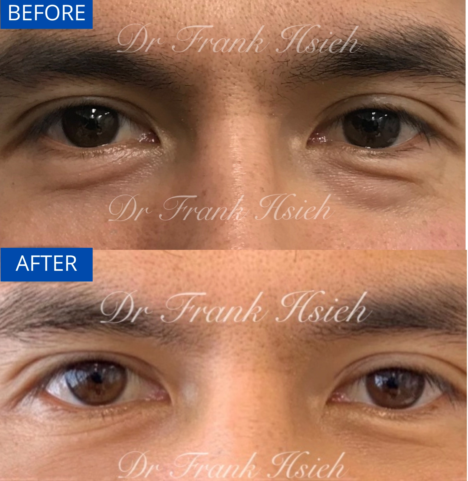 Eyebags Removal Lower Blepharoplasty Internal Scarless Case 4 Before and After