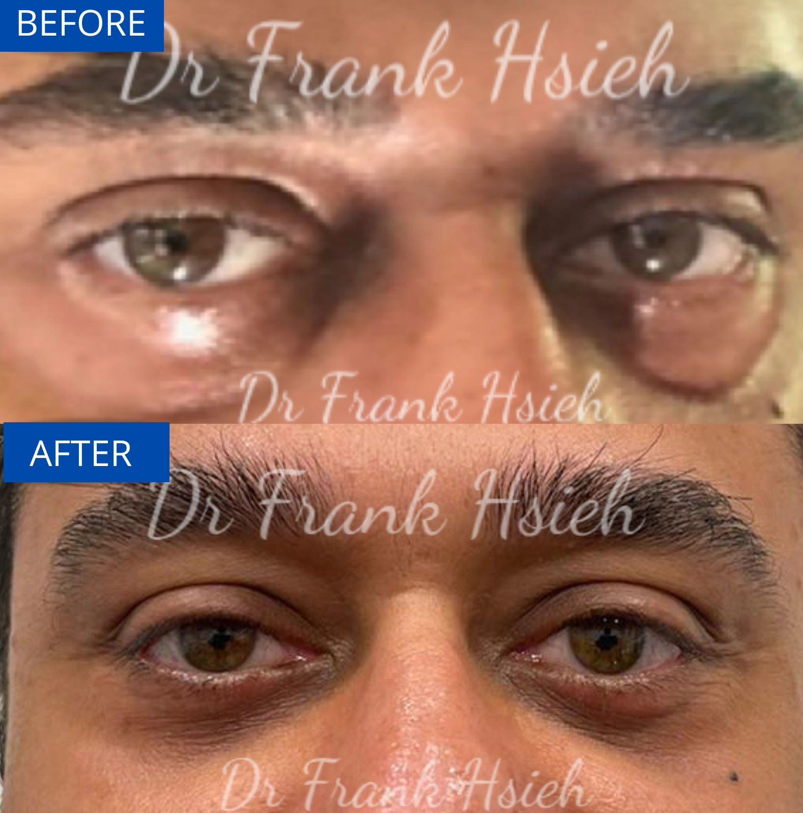 Eyebags Removal Lower Blepharoplasty Internal Scarless Case 5 Before and After