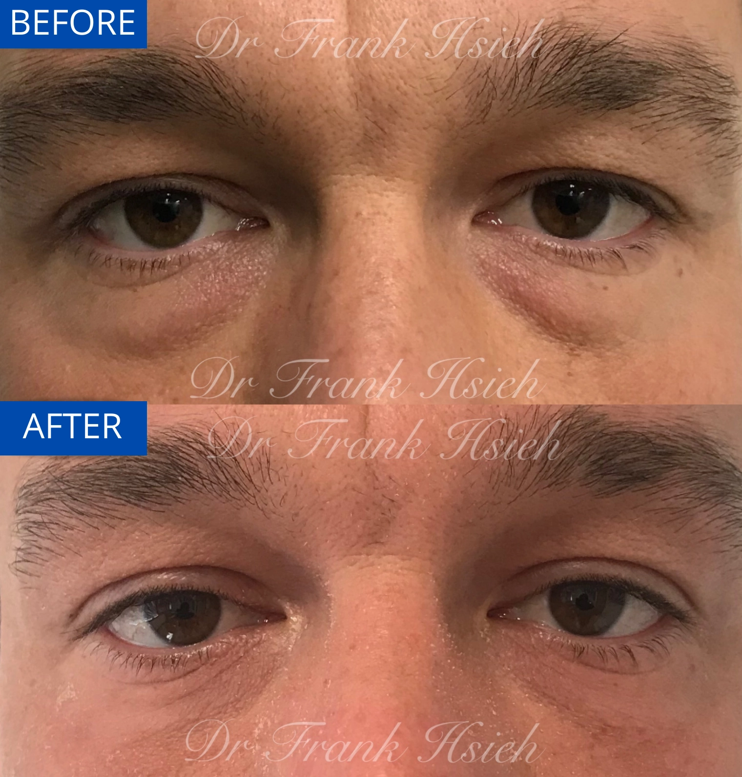 Eyebags Removal Lower Blepharoplasty Internal Scarless Case 6 Before and After