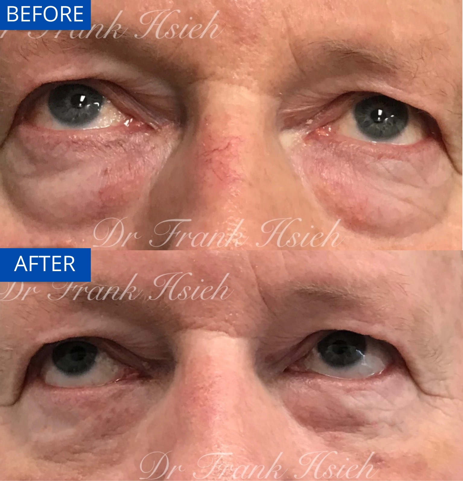 Eyebags Removal Lower Blepharoplasty Internal Scarless Case 7 Before and After Look Up