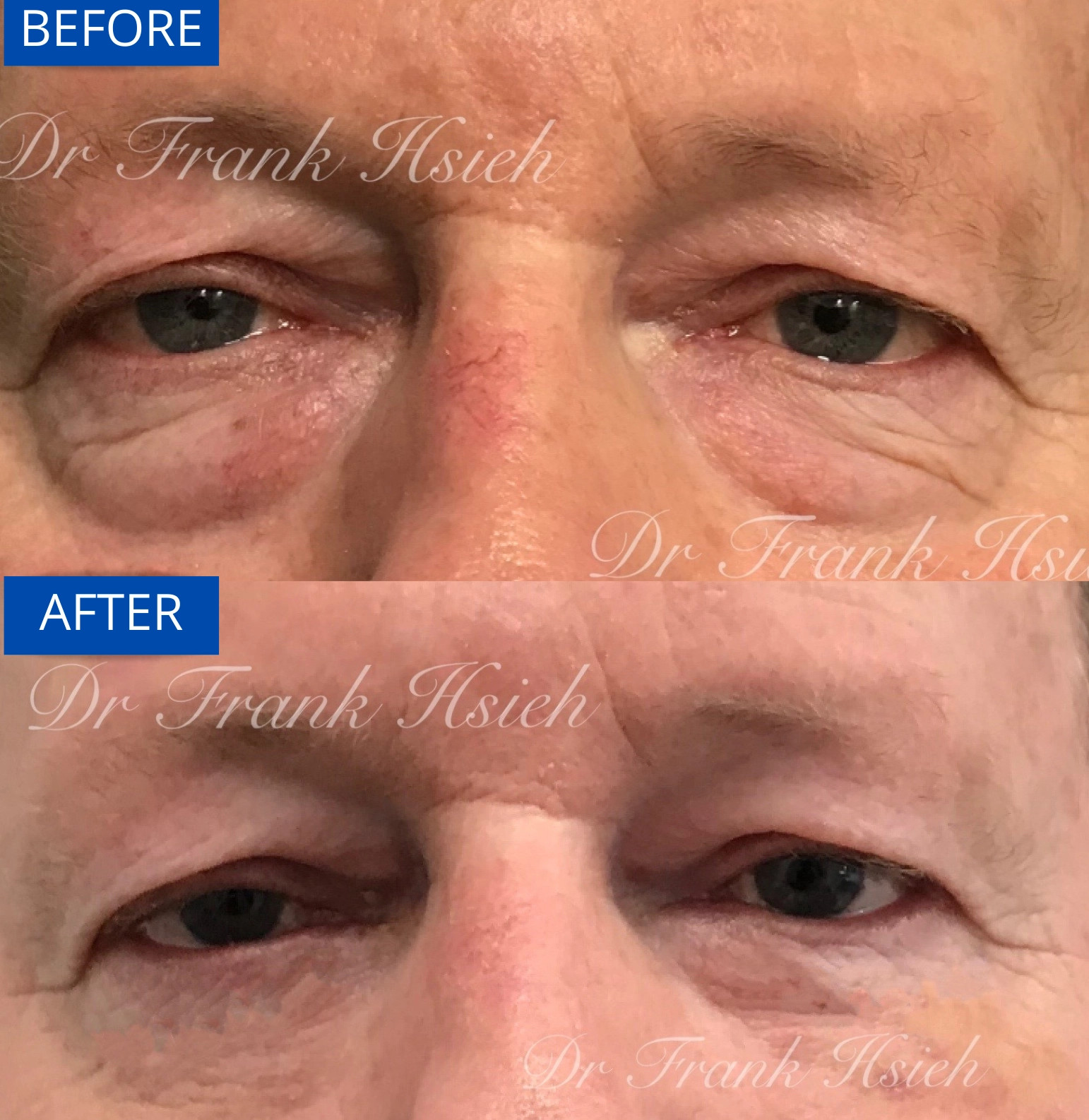 Eyebags Removal Lower Blepharoplasty Internal Scarless Case 7 Before and After