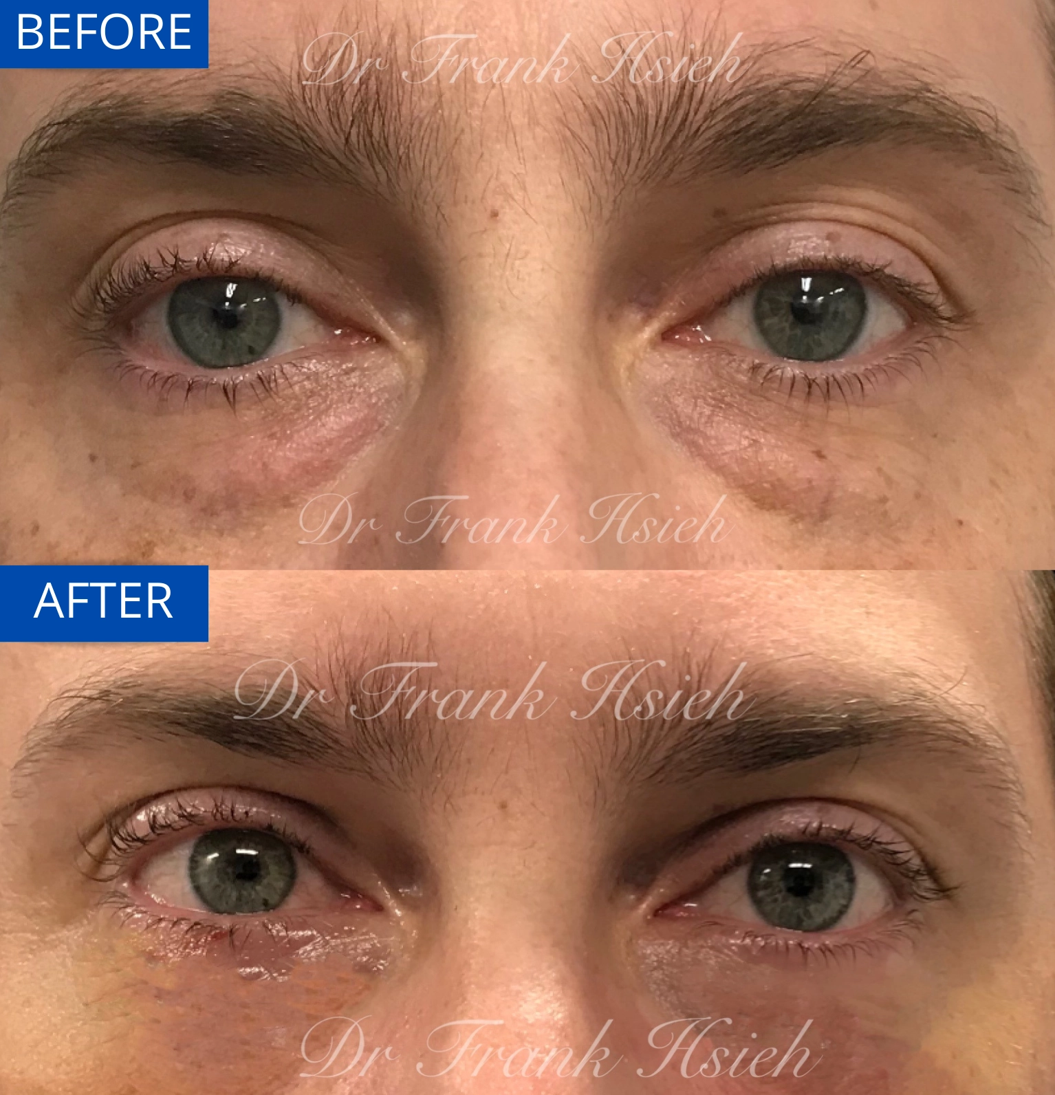Eyebags Removal Lower Blepharoplasty Internal Scarless Case 8 Before and After