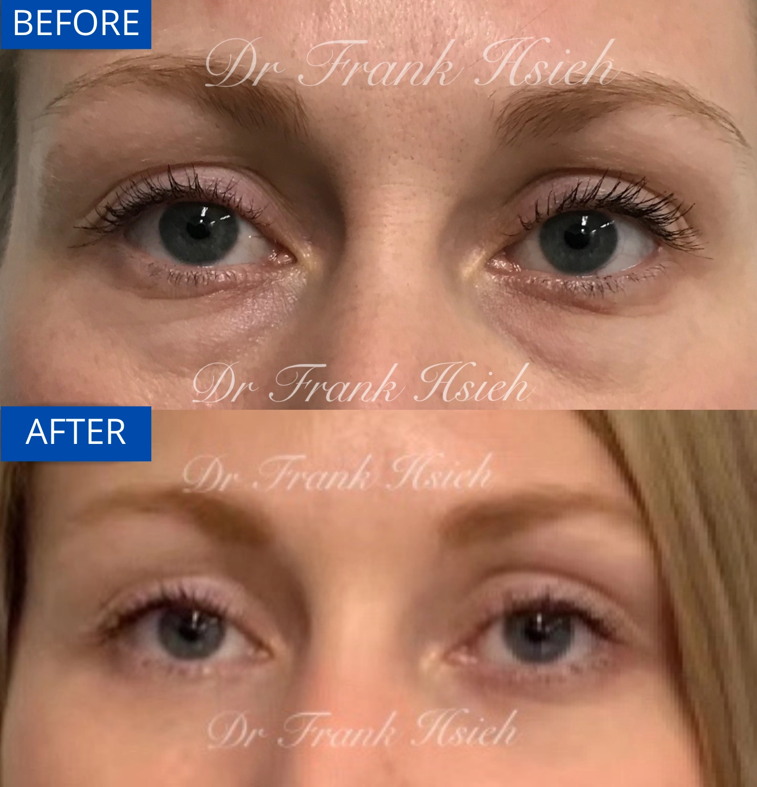Eyebags Removal Lower Blepharoplasty Internal Scarless Case 9 Before and After