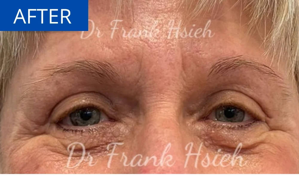 Eyelid Upper Blepharoplasty Incisional Minimal Scar Case 1 After