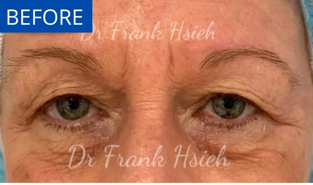 Eyelid Upper Blepharoplasty Incisional Minimal Scar Case 1 Before