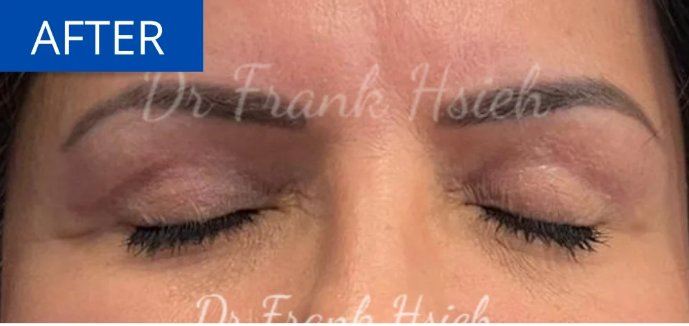 Eyelid Upper Blepharoplasty Incisional Minimal Scar Case 2 After Eyes Closed