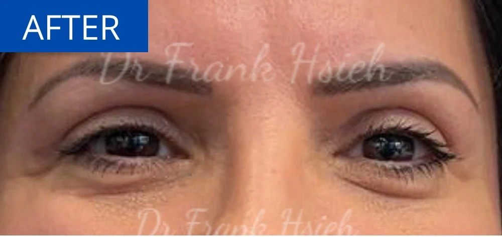 Eyelid Upper Blepharoplasty Incisional Minimal Scar Case 2 After Eyes Opened