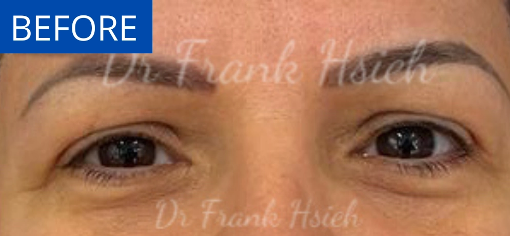 Eyelid Upper Blepharoplasty Incisional Minimal Scar Case 2 Before
