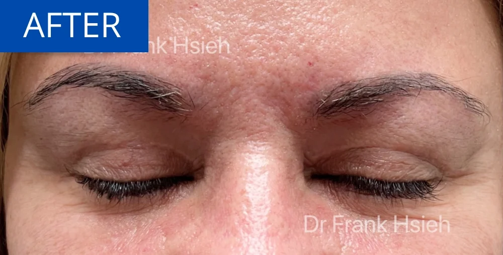 Upper Blepharoplasty Incisional Minimal Scar Case 3 After Eyes Closed