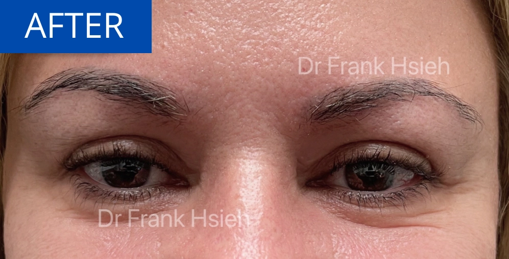 Eyelid Upper Blepharoplasty Incisional Minimal Scar Case 3 After Eyes Opened