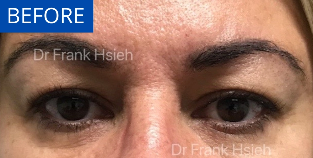 Eyelid Upper Blepharoplasty Incisional Minimal Scar Case 3 Before