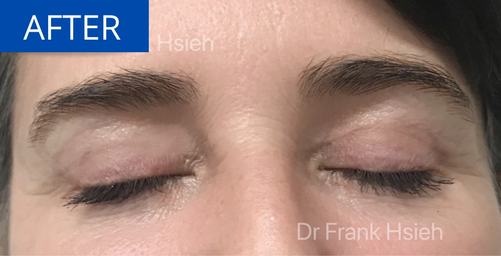 Upper Blepharoplasty Incisional Minimal Scar Case 4 After Eyes Closed
