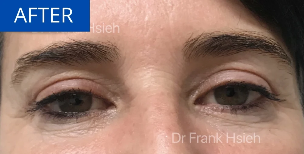 Upper Blepharoplasty Incisional Minimal Scar Case 4 After Eyes Opened