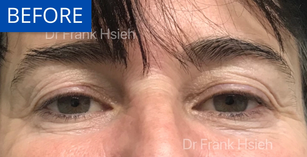Upper Blepharoplasty Incisional Minimal Scar Case 4 Before