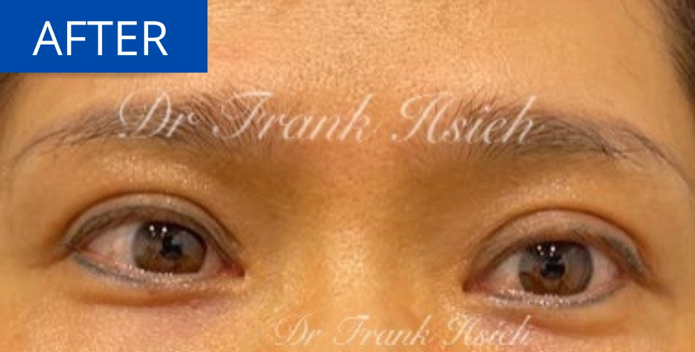 Upper Blepharoplasty Incisional Minimal Scar Case 5 After Eyes Opened
