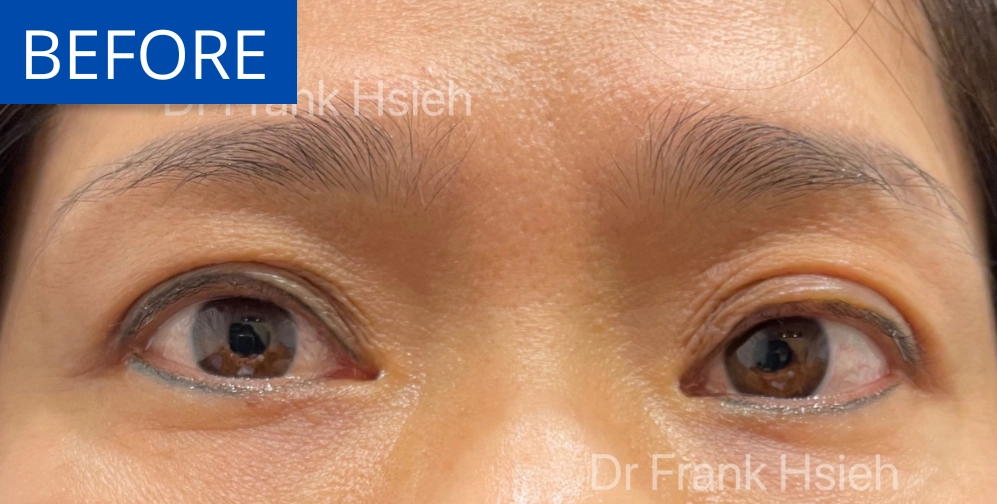 Upper Blepharoplasty Incisional Minimal Scar Case 5 Before