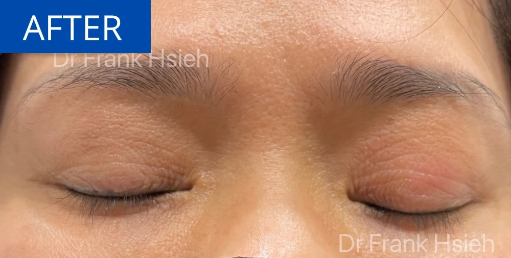 Upper Blepharoplasty Incisional Minimal Scar Case 5 After Eyes Closed