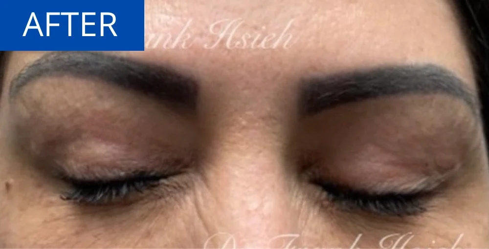 Upper Blepharoplasty Incisional Minimal Scar Case 6 After Eyes Closed