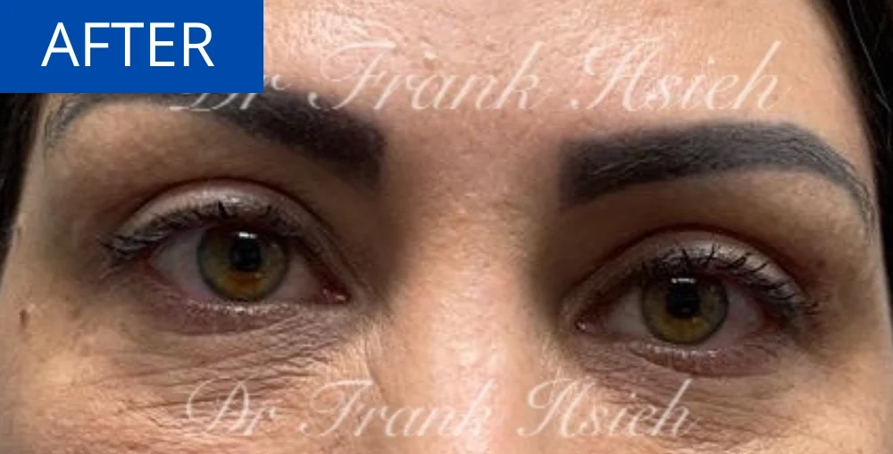 Upper Blepharoplasty Incisional Minimal Scar Case 6 After Eyes Opened