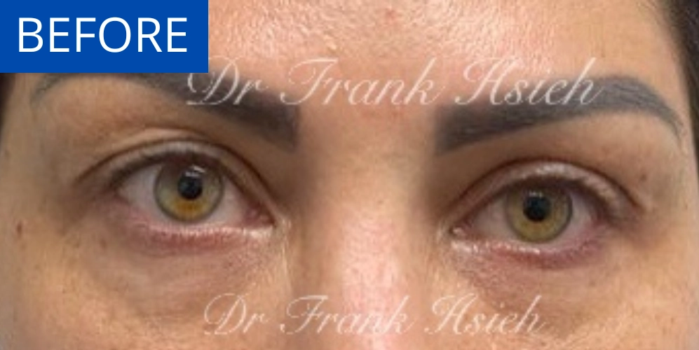 Upper Blepharoplasty Incisional Minimal Scar Case 6 Before
