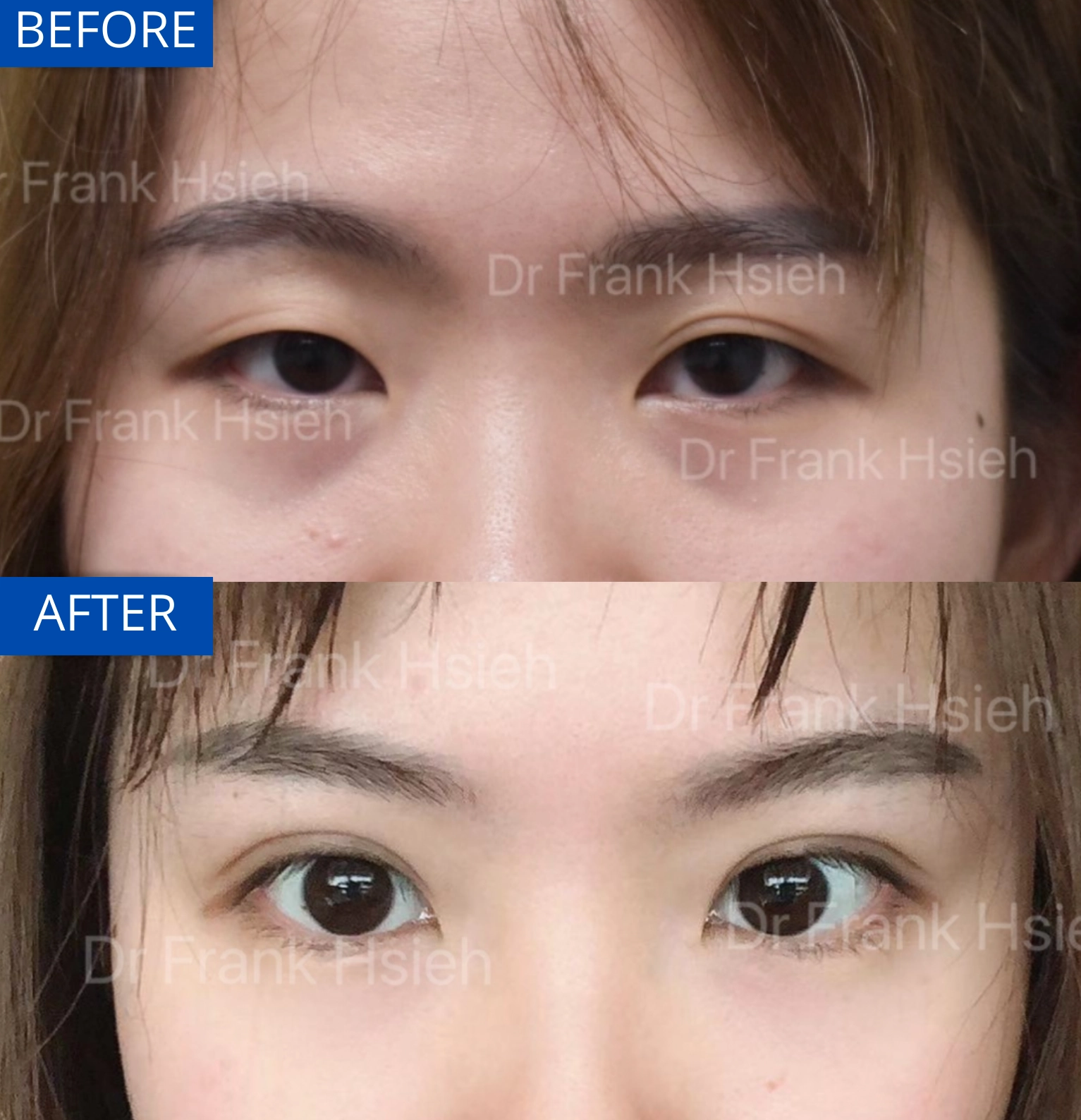 Eyelid Upper Blepharoplasty Non-Incisional Scarless Case 1 Before and After