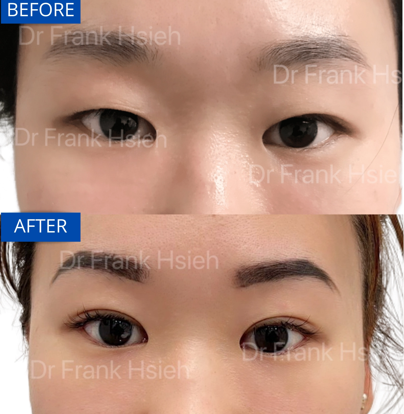 Eyelid Upper Blepharoplasty Non-Incisional Scarless Case 2 Before and After
