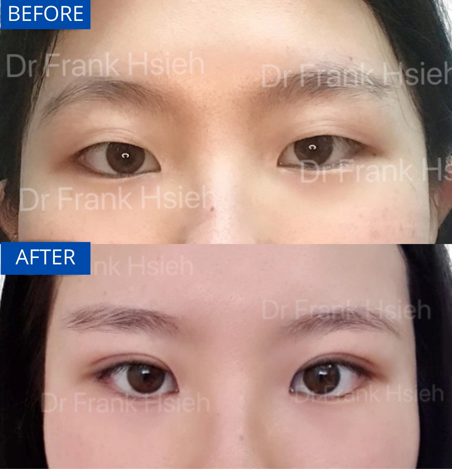 Eyelid Upper Blepharoplasty Non-Incisional Scarless Case 3 Before and After