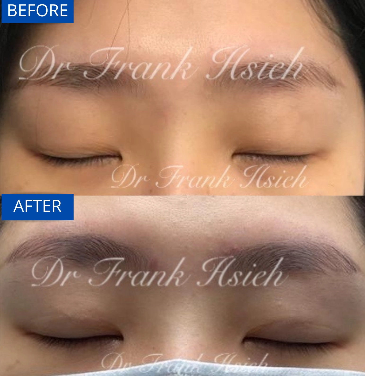 Eyelid Upper Blepharoplasty Non-Incisional Scarless Case 4 Before and After Eyes Closed