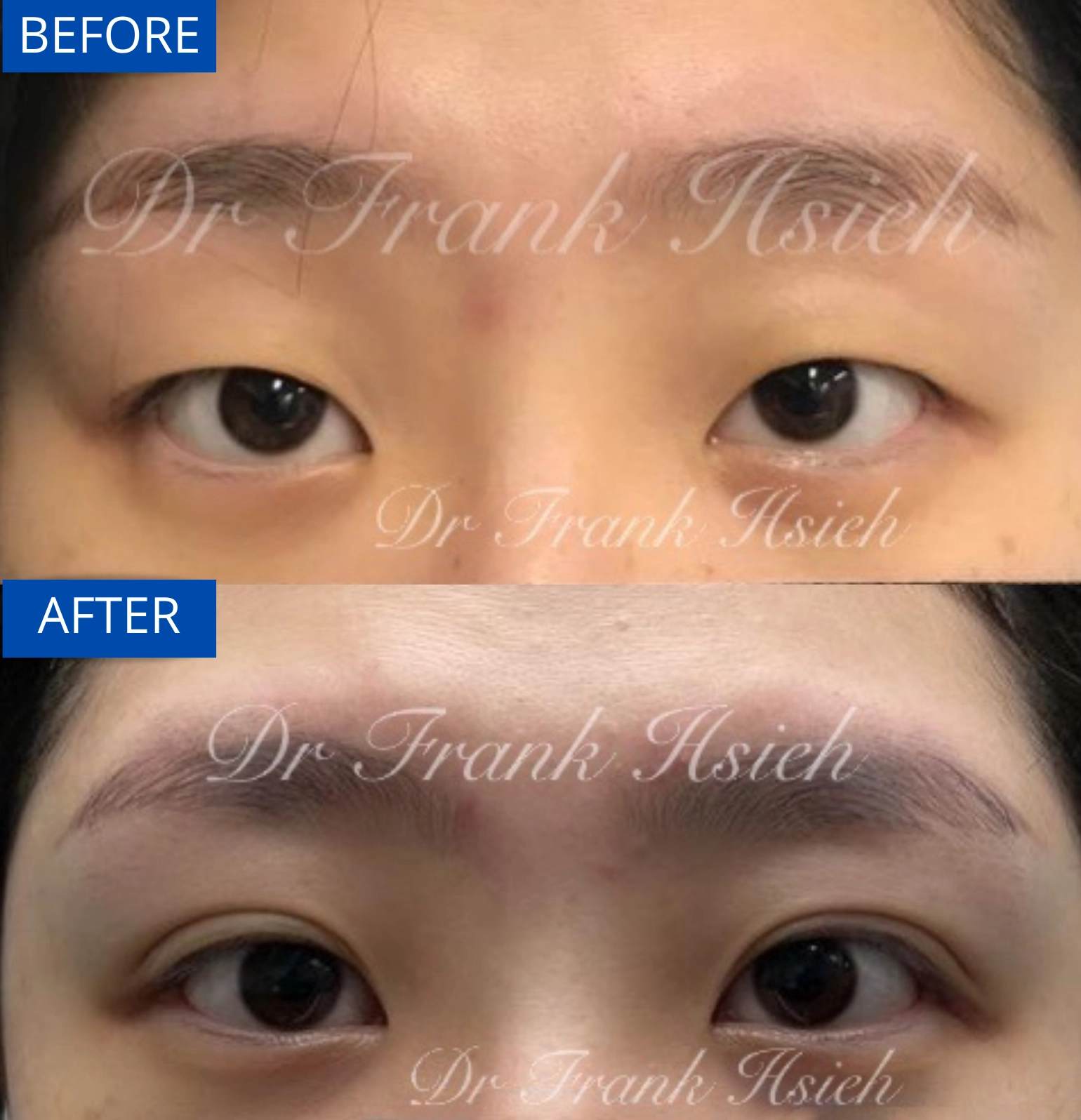 Eyelid Upper Blepharoplasty Non-Incisional Scarless Case 4 Before and After Eyes Opened