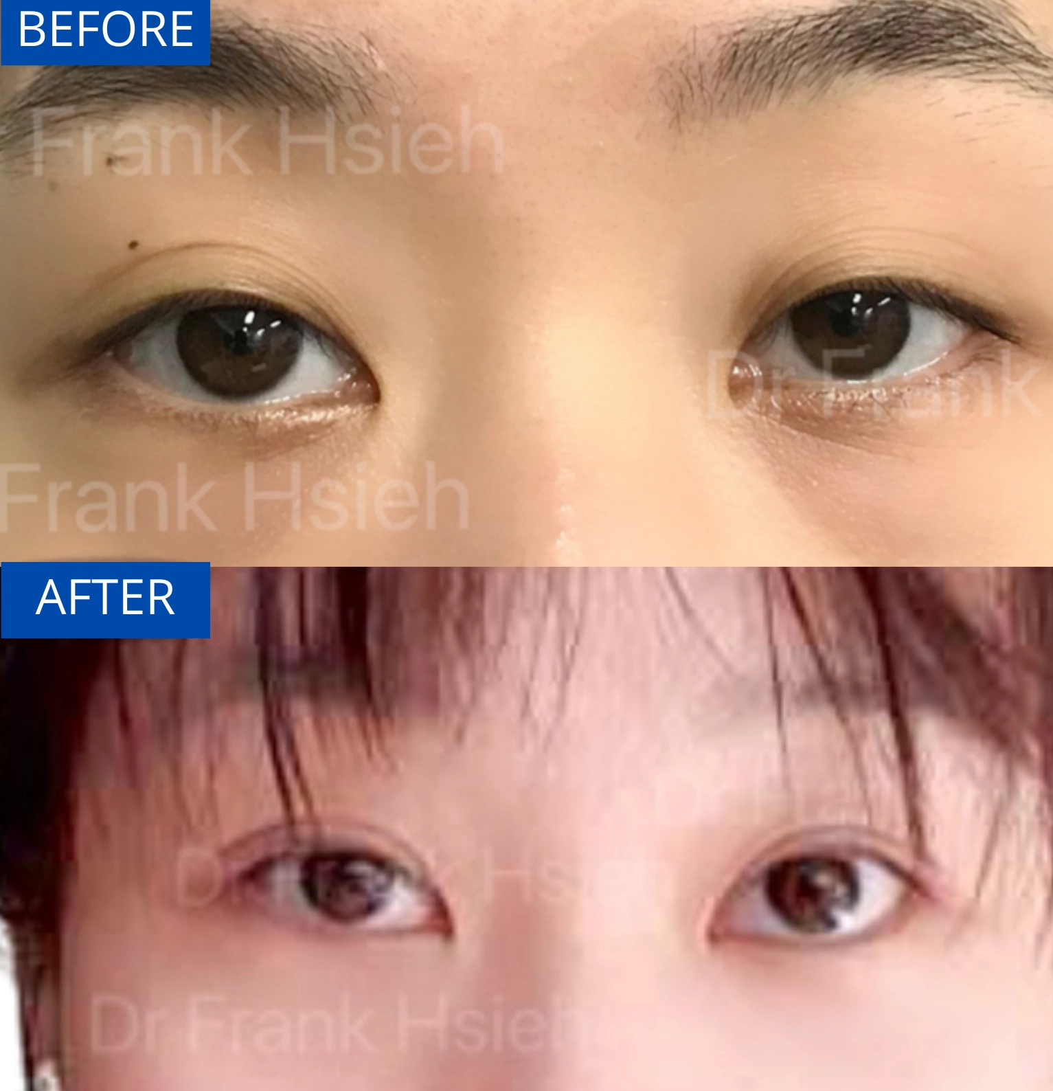 Eyelid Upper Blepharoplasty Non-Incisional Scarless Case 5 Before and After