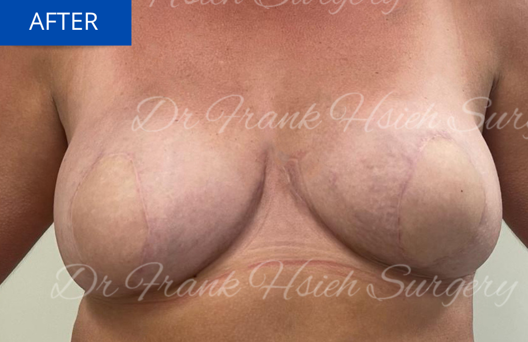 Immediate Breast Reconstruction After Mastectomy