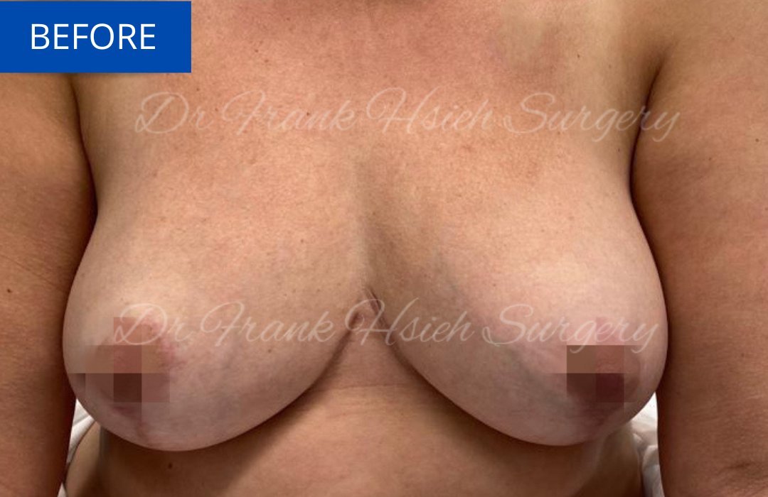 Immediate Breast Reconstruction Before Mastectomy
