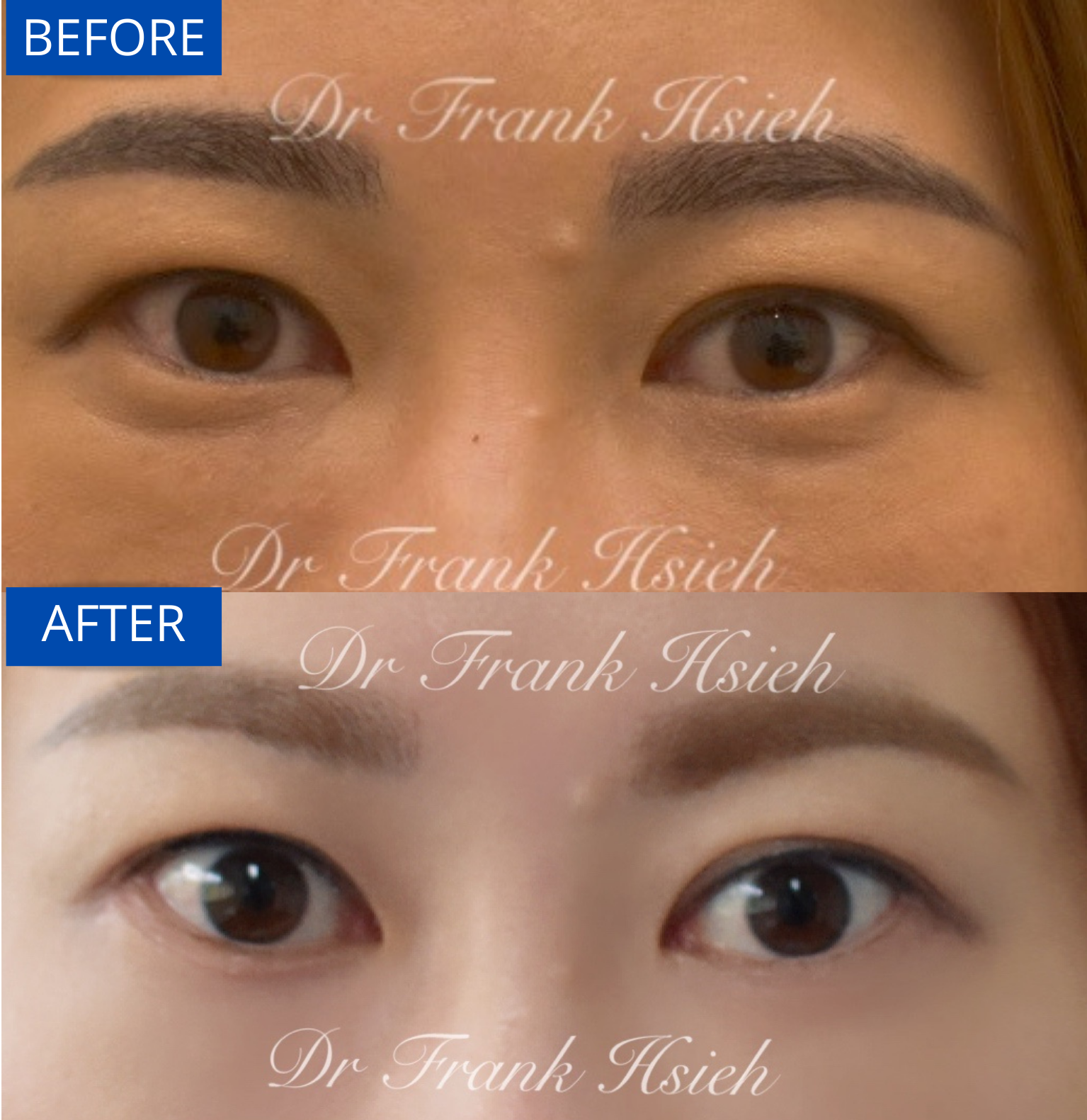 Eye Bag removal Eye Bag Removal